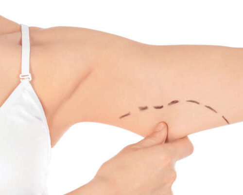 arm-lift Woman with marks on arm for cosmetic surgery operation against white background, closeup