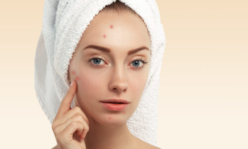 Close up shot of young Caucasian female with blue eyes and acne skin, pointing at pimple, looking at the camera while getting facial treatment in spa salon. Dermatology and problem skin concept Close up shot of young Caucasian female with blue eyes and acne skin, pointing at pimple, looking at the camera while getting facial treatment in spa salon. Dermatology and problem skin concept