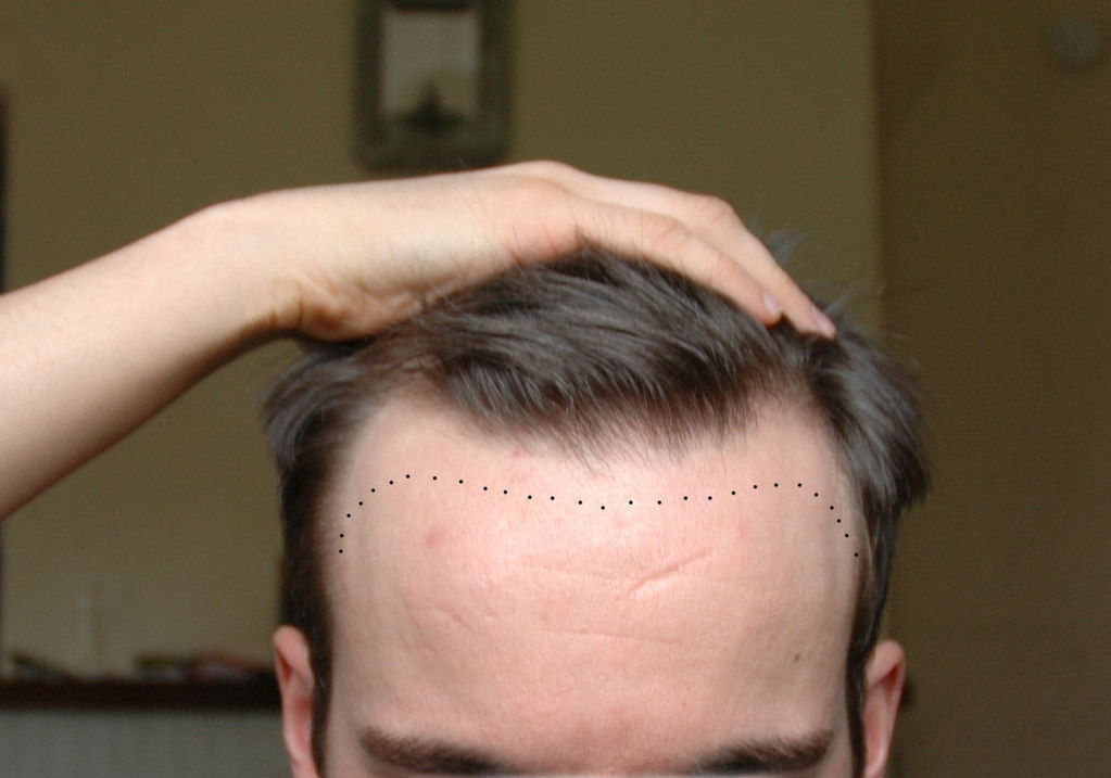 Prominent Forehead correction Dr. Ranjit Bhosle - Best Plastic Surgeon | Gynecomastia | Cyst Removal | Lipoma | Breast Surgery | Liposuction Expert.Dr. Ranjit Bhosale - Best Plastic Surgeon | Gynecomastia | Liposuction Expert| Cyst Removal Lipoma | Hair, Transplant. Ghatkopar West, , Borivali East, Mumbai, Maharashtra,Maroshi Rd Andheri.